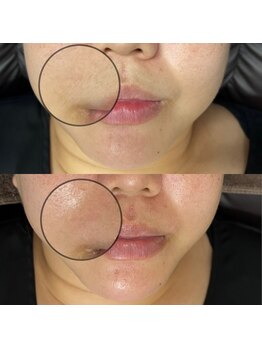 シェリートーキョー 成田店(Cherie Tokyo)/Before＆After /成田店