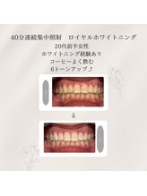 プラスビーセルフ(+b self)/ホワイトニングビフォーアフター