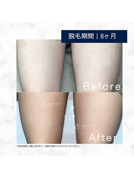 メンズクリア 松本店/【メンズクリア】お客様の施術例