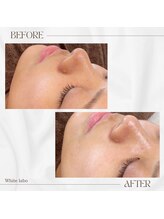 ホワイトラボ 梅田(White labo)/毛穴ケア◆ハイドロフェイシャル