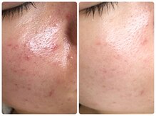 シェミー(CHEZ MEE)/赤み/皮脂/肌トラブル気になる方