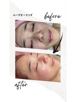 ベル(Belle)/ハーブピーリング￥9,800
