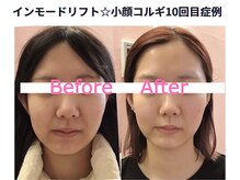 サロン ド シャーロット 恵比寿の雰囲気（韓国最新美容インモードリフト☆切らずに小顔＆リフトアップ↑）