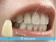 ホワイトニングカフェ 豊中店(WhiteningCafe)/◎歯のホワイトニング施術写真◎