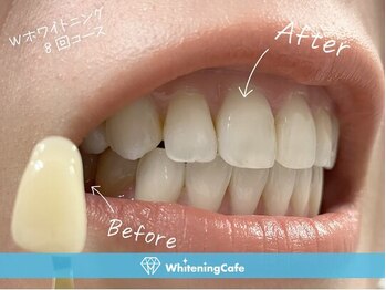 ホワイトニングカフェ 豊中店(WhiteningCafe)/◎歯のホワイトニング施術写真◎
