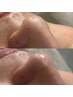 月に一度の自分メンテ♪鼻あごワックス＋角栓除去＋下半顔～首ハイドロ8900→