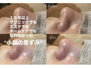 ジューンブライド(June Bride 61)/クリニックで取れなかった黒ずみ
