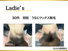 アルゴ 堺東駅前店(ALGO)/うなじワックス+うなじ脱毛