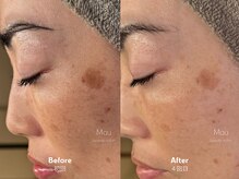 マウ(Mau)/シミケア＋マシン2種