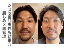 ソルレ 宮崎店(SOLURe)/シミ改善◎ 腸もみ×肌管理