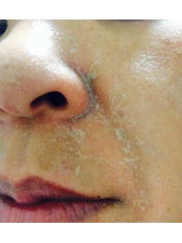 グリーンピールサロン ラニ(Lani)/グリーンピール5daysの不要角質