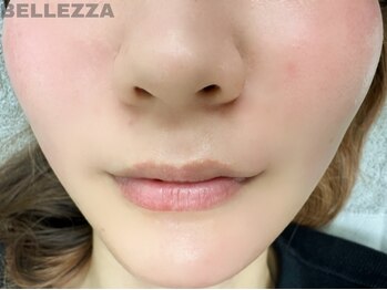 ベリザ 笹塚店(BELLEZZA)の写真/【古い角質もすっきリ!毛穴にも◎】透明感のある美肌へ♪春はフルフェイスWAXでトーンUP!¥5280~☆