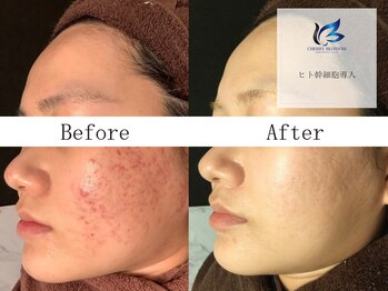 チェリーブロッサム 恵比寿店(CHERRY BLOSSOM)/ニキビ肌改善