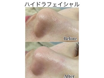 ル ポム バイ ティアム 神戸元町(Le pom by TIAM)/毛穴洗浄 ハイドラフェイシャル