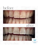 ホワイトニングショップ 広島店(WHITENING SHOP)/【ホワイトニング】Before After
