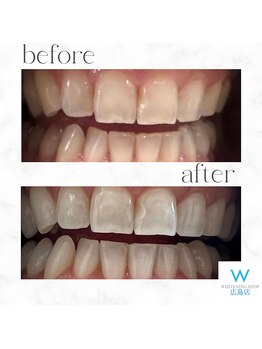 ホワイトニングショップ 広島店(WHITENING SHOP)/【ホワイトニング】Before After