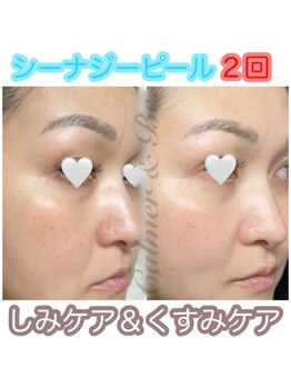 カルマーアンドビー(Calmer & Be.)/【シーナジピール】Before/After