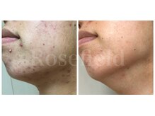 ローズフィールド(Rosefield)/30代　ニキビ（1年）