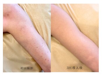 モネ(monet)/グリーンピール二の腕