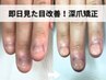【深爪/噛み爪/むしり爪】即日見た目改善！深爪矯正初回お試し
