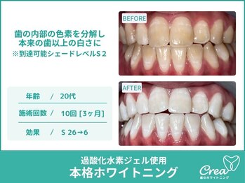 クレア(Crea)/【ホワイトニング症例写真】