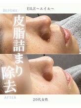 エイル(EILE)/症例