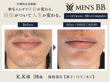 メンズビービー 福井高柳店(MEN'S BB)の雰囲気（国産最新式男性専用脱毛機を使用！痛みは抑えてしっかり効果！）