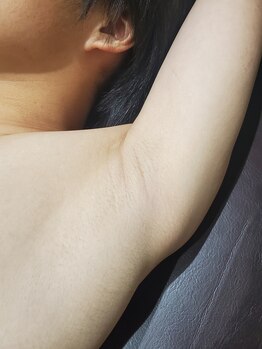 ラクト サロン(RAKT salon)/ワキ脱毛