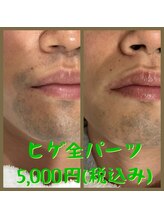 リアンジュ/ヒゲ脱毛の経過