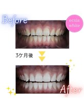 エクシアホワイトニング 原宿店/ホワイトニングビフォーアフター