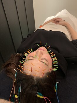 ジェイペック鍼灸整骨院/美容鍼80本プレミアム