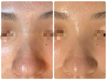 エヌエースキン センター北店(NA skin)/ハーブピーリング｜毛穴洗浄