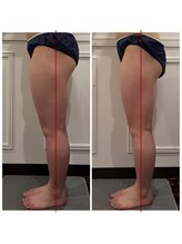 心斎橋 ルヴィ(REVI)/脚太もも/下半身/痩身ダイエット