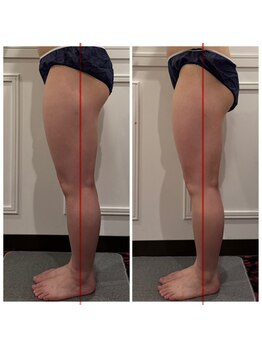 心斎橋 ルヴィ(REVI)/脚太もも/下半身/痩身ダイエット