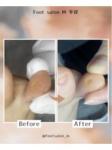 エム 平岸(M)/【魚の目/タコ】女性