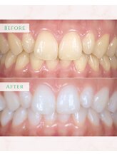 シカホワイトニングトウキョウ 笹塚店(CICA Whitening Tokyo)/ビフォーアフター（10代女性）