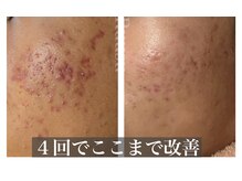 辛い青春ニキビも1日でも早く改善して笑顔に自信持ちましょう！