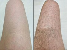 セルフメイド 東大阪店(SELFMADE)/太ももの脱毛