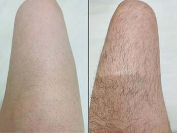 セルフメイド 東大阪店(SELFMADE)/太ももの脱毛