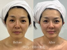 グランディールスイート(GRANDIR suite)/FACE MAKER施術結果