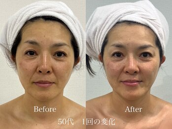 グランディールスイート(GRANDIR suite)/FACE MAKER施術結果