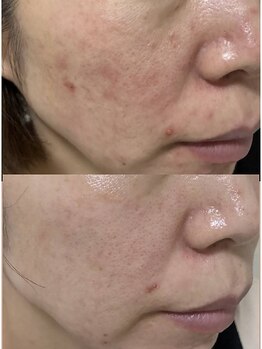 ルカクリニカル(Luka.CLINICAL)の写真/毛穴改善や小顔に最先端韓国式LDMが登場。美容のプロが提案するツルツル肌へ♪