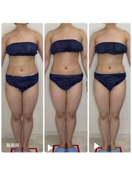 カプリス(CAPRiCE)/リンパドレナージュ