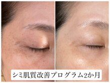 ヌー 栄(nuu)/シミ肌質改善プログラム2か月