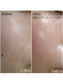 シースキン 盛岡駅前店(c.skin)/お客様ビフォーアフター