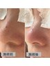 本気の肌質改善【インディバフェイシャル+毛穴ケア】でハリ・ツヤアップ☆