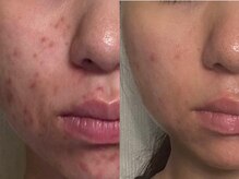 ニキビでお悩みの方はぜひハーブエステをお試しください！