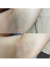 アンドミー(and me)/鹿児島/唐湊/脱毛/脇脱毛/メンズ