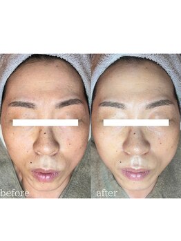 フィエルテ(Fielte)/シミ/シワ/ハリ/艶肌