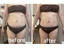 リムアール(Limh R)/ビフォーアフター